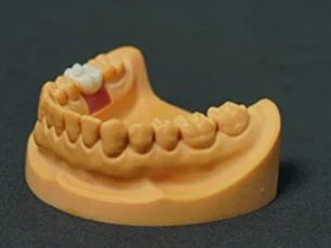 Kjenner du disse kravene til orale implantatmaterialer?