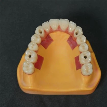 All On Four-implantat